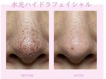 バービーフェイス 恵比寿(Barbie Face)/毛穴 黒ずみ除去 水光ハイドロ