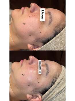 ディオーネ 春日井勝川店(Dione)/マーメイドセルトリートメント