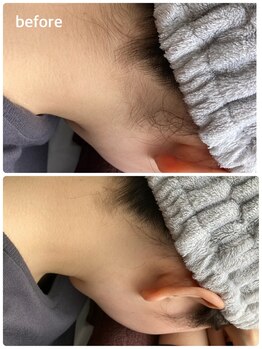 サンタ(santa)/うなじ脱毛でセクシーに♪