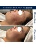 〈ニキビケア〉　敏感肌を根本から改善 跡・赤ら顔に効果的　¥4,980