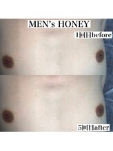 ハニーアイズ(Honey Eyes)/胸＆お腹脱毛施術【メンズ脱毛】