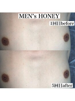 ハニーアイズ(Honey Eyes)/胸＆お腹脱毛施術【メンズ脱毛】