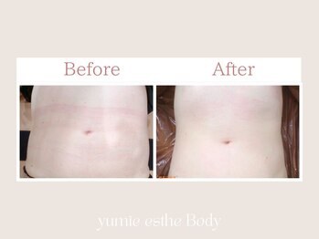 トータルビューティー ゆみえエステ(Total Beauty)/痩身/マグシェイプ ウエスト