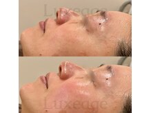 プライベートサロン ルクサージュ(Luxeage)/スパークリング小顔フェイシャル