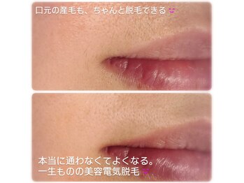 ベビースキン(baby skin)/美容電気脱毛