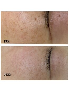 ベルフィーヌ ノーブル(BELLEFINE noble)/シミケア３回目＆シロナル使用