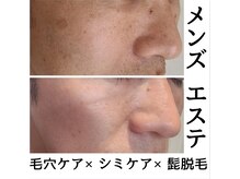 男性も美肌の時代♪毛穴ケア×シミケア×ヒゲ脱毛☆清潔感♪