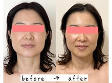 幸せ甦顔/エラは一生このままかと思ってた