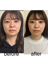 マホロバ(mahoroba)/小顔、たるみ改善美容鍼
