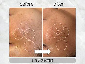 ベリール バイ ラスティ(Belile by LUSTY)/シミケア+ラミピール