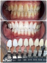 エクシアホワイトニング 札幌中島公園店/Before After［ホワイトニング］