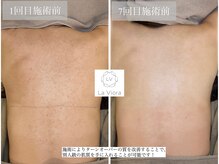 ラヴィオーラ 川西(La Viora)/ダイヤモンドハーブピーリング