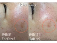 リル バイ アンドアール(Rire by and.R)/シミケア（施術1回）