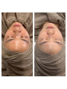 モンド 駒込店(monde)/ハーブピーリング