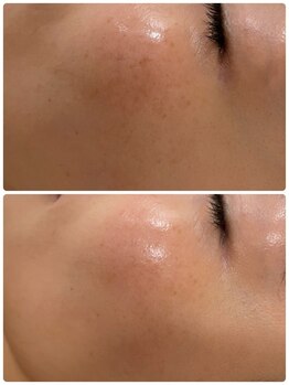 ヴィテラス バイ アリア(Veteras by aria)/☆ハイドラフェイシャル☆