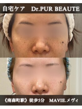 サロン ド メヴィ(SALON DE MAVIE)/【シミケア】