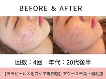 ア クーユ 稲毛店/ハーブピーリング/ニキビケア