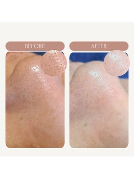 エミナル バイ ニコドット(Eminal by nico.)/毛穴の黒ずみ2回目ケア後