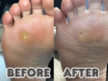 ポドロ ウィズ ニコルル 大阪天満店(PoDoLo with Nicolulu)/【魚の目】フットケア大阪・梅田