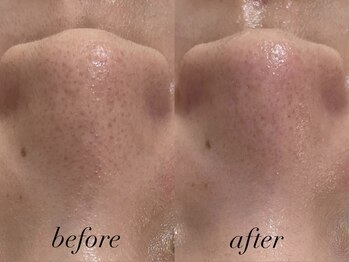 リスポアラボ(LIS PORE.LAB)/1回before after