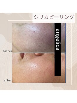 アンジェリカ(Angelica)/シリカピーリング