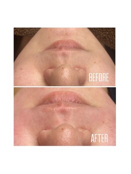 ホワイトワックス 京都四条烏丸(WHITE WAX)/お口周りふわふわ毛もスッキリ★