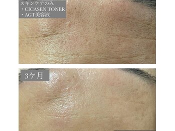 スウィート 矢場町店(Sweet)/TROIAREUKEスキンケア