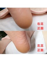 ドクターネイル爪革命 長野店/【角質ケア】リラク/足裏