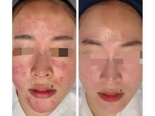 モアナ(Moana)/ニキビケア┃Before/After