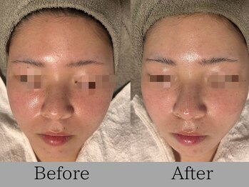 ルミライズ(lumirise)/〈2回目での効果〉