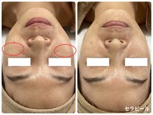 クリア 尾張旭店(Clear)/【セラピールビフォーアフター】