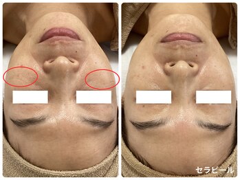 クリア 尾張旭店(Clear)/【セラピールビフォーアフター】