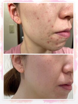 カブール 町田/ひと味違うハーブピーリング