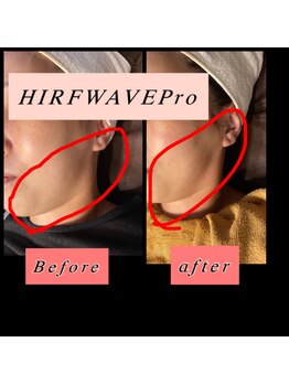 ティアメディカル(Tia Medical)/HIRFWAVEPro