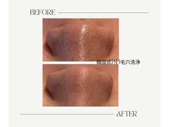 サロンアールミヨン(Salon R Miyon)/韓国式3D毛穴洗浄