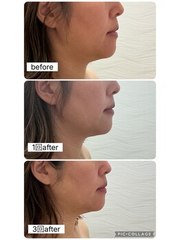 エスビーエス オキナワ(SBS OKINAWA)/レモンボトルモニター様