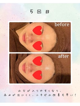 リリアン(lirien)/毛穴/毛穴ケア/毛穴洗浄/駒込