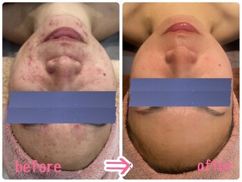 ヴィータローズディセ 名古屋本店(VITA ROSE Desse)/オーダーメイドフェイシャル