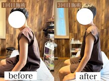 アポヨ鍼灸院(APOYO鍼灸院)/鍼整体　before/after