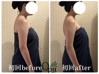 キュープ 福岡天神店(Qpu)/巻き肩コース1回での変化