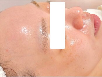 ボディメイキング キキ(Bodymaking KIKI)/スキングロウ水光ピール