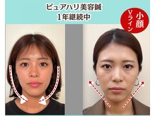 ピュアハリ/沖縄美容鍼 効果