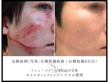 韓国肌管理室 ソア(soa)/【前代未聞の○○による回復力】