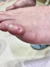フットメンテ 巻き爪矯正センター 南浦和/魚の目ケア