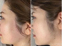 エヴァワックス 恵比寿店(Eva Wax)/【もみあげ脱毛】ビフォ-アフタ-