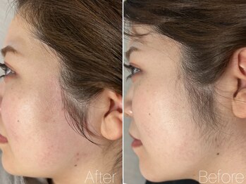 エヴァワックス 恵比寿店(Eva Wax)/【もみあげ脱毛】ビフォ-アフタ-