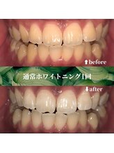 フタバ 天神大名店(futaba)/初回ホワイトニングbefore after
