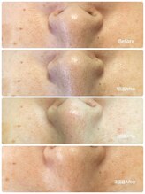 ビトタン 倉敷本店(+美to鍛)/ハーブピーリング/３回