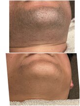 グロー(GLOW)/メンズヒゲ脱毛