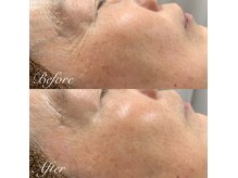 剥離なし◎REVI陶肌トリートメント